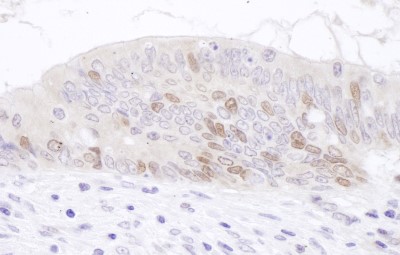 Immunohistochemistry: PCNA associated factor Antibody [NBP2-32117] - Sample: FFPE section of human prostate carcinoma. Antibody: Affinity purified rabbit anti- PAF used at a dilution of 1:1,000 (1ug/ml). Detection: DAB. Counterstain: IHC Hematoxylin (blue).