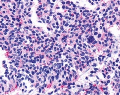 Immunohistochemistry-Paraffin: Muscarinic Acetylcholine Receptor M5/CHRM5 Antibody [NLS1338] - Analysis of anti-CHRM5 / M5 antibody with human lung, small cell carcinoma.