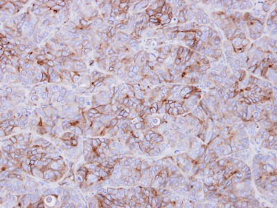 Immunohistochemistry-Paraffin: Galanin Receptor 3 Antibody [NBP2-16577] - Immunohistochemical analysis of paraffin-embedded SW480 xenograft, using antibody at 1:500 dilution.