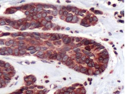 Immunohistochemistry-Paraffin: Lamin B Receptor Antibody [NBP1-49760] - Human Breast Carcinoma