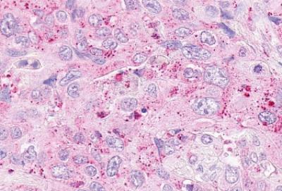 Immunohistochemistry-Paraffin: OXER1/5-oxo-ETE GPCR Antibody [NLS2272] - Human Pancreas, Carcinoma. Immunohistochemistry of formalin-fixed, paraffin-embedded tissue after heat-induced antigen retrieval.