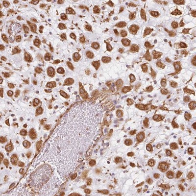 Immunocytochemistry/Immunofluorescence: FOXR2 Antibody [NBP2-56756] - Immunohistochemical staining of human placenta shows strong cytoplasmic positivity in decidual cells.