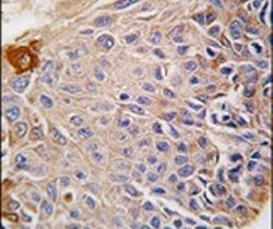 Immunohistochemical analysis of formalin-fixed, paraffin-embedded human lung carcinoma tissue using a RMND5B polyclonal antibody (Product ## PA5-12399), followed by HRP-conjugated secondary antibody and DAB staining.