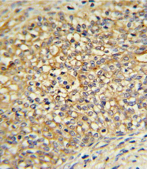 Immunohistochemistry analysis in formalin-fixed, paraffin-embedded human prostate carcinoma using a UDB17 polyclonal antibody (Product # PA5-13430), followed by HRP-conjugated secondary antibody and DAB staining.