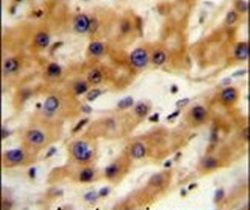 Immunohistochemistry analysis in formalin-fixed, paraffin-embedded human hepatocarcinoma using a GAGE13 polyclonal antibody (Product ## PA5-24068), followed by HRP-conjugated secondary antibody and DAB staining.