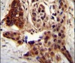 Immunohistochemistry analysis in formalin-fixed, paraffin-embedded human bladder carcinoma using a CCDC122 polyclonal antibody (Product ## PA5-24342), followed by HRP-conjugated secondary antibody and DAB staining.