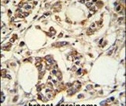 Immunohistochemistry analysis in formalin-fixed, paraffin-embedded breast carcinoma using a PIGM polyclonal antibody (Product ## PA5-24687), followed by HRP-conjugated secondary antibody and DAB staining.