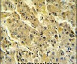 Immunohistochemistry analysis in formalin-fixed, paraffin-embedded hepatocarcinoma using a PSG7 polyclonal antibody (Product ## PA5-24864), followed by HRP-conjugated secondary antibody and DAB staining.