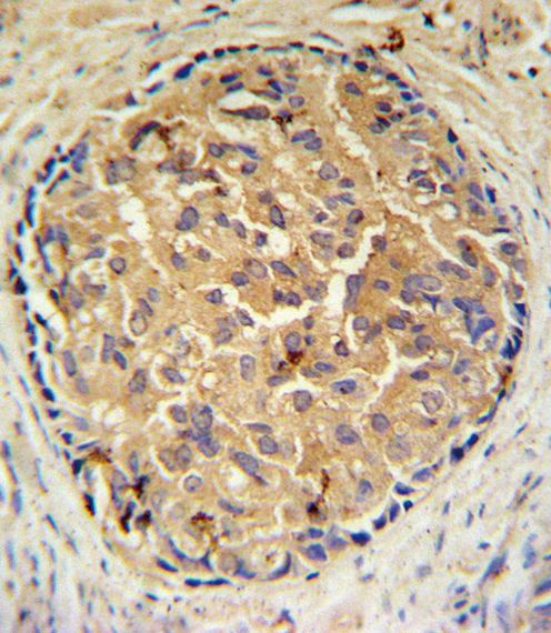 Immunohistochemistry analysis in formalin-fixed, paraffin-embedded human prostate carcinoma using a SRD5A3 polyclonal antibody (Product # PA5-25200), followed by HRP-conjugated secondary antibody and DAB staining.