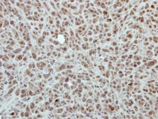 Immunohistochemical analysis of RPP30 in paraffin-embedded PC9 xenograft using a RPP30 polyclonal antibody (Product # PA5-31009) at a dilution of 1:500.
