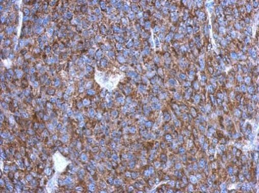Immunohistochemical analysis of OVCA2 in paraffin-embedded BT483 xenograft using an OVCA2 polyclonal antibody (Product # PA5-31447) at a dilution of 1:500.