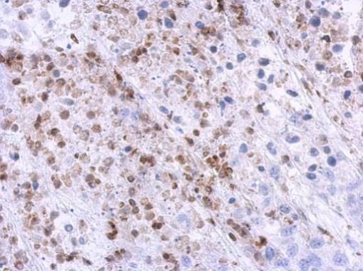 Immunohistochemical analysis of U1SNRNPBP in paraffin-embedded HeLa xenograft using a U1SNRNPBP polyclonal antibody (Product # PA5-31496) at a dilution of 1:500.