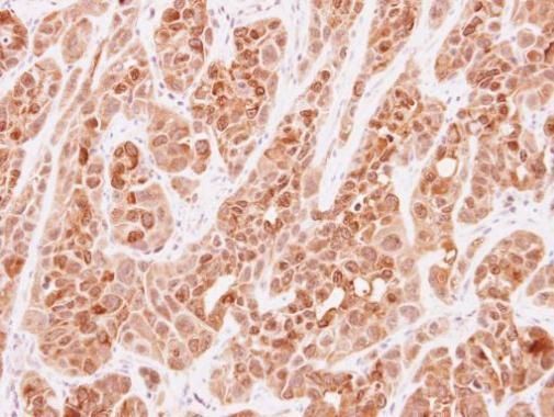 Immunohistochemical analysis of SGK493 in paraffin-embedded H358 xenograft using a SGK493 polyclonal antibody (Product # PA5-31510) at a dilution of 1:250.