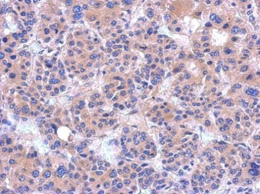 Immunohistochemical analysis of PDZRN4 in paraffin-embedded hepatoma using a PDZRN4 polyclonal antibody (Product # PA5-31569) at a dilution of 1:500.