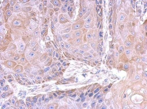 Immunohistochemical analysis of Olfactomedin-like 3 in paraffin-embedded Cal27 xenograft using an Olfactomedin-like 3 polyclonal antibody (Product # PA5-31581) at a dilution of 1:500.