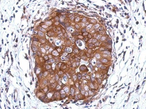 Immunohistochemical analysis of DCUN1D2 in paraffin-embedded breast carcinoma using a DCUN1D2 polyclonal antibody (Product # PA5-31607) at a dilution of 1:500.
