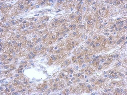 Immunohistochemical analysis of ALS2CR12 in paraffin-embedded U373 xenograft using an ALS2CR12 polyclonal antibody (Product # PA5-31636) at a dilution of 1:500.