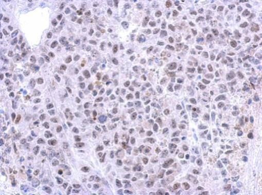Immunohistochemical analysis of RRP12 in paraffin-embedded HeLa xenograft using a RRP12 polyclonal antibody (Product # PA5-31659) at a dilution of 1:500.