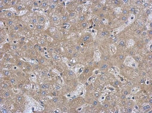Immunohistochemical analysis of FAM171A1 in paraffin-embedded hepatoma using a FAM171A1 polyclonal antibody (Product # PA5-31666) at a dilution of 1:500.