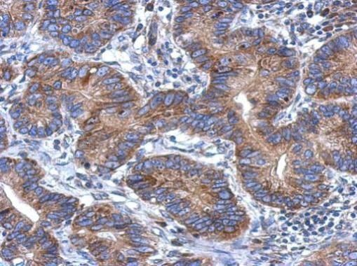 Immunohistochemical analysis of CCDC70 in paraffin-embedded colon carcinoma using a CCDC70 polyclonal antibody (Product # PA5-31679) at a dilution of 1:500.