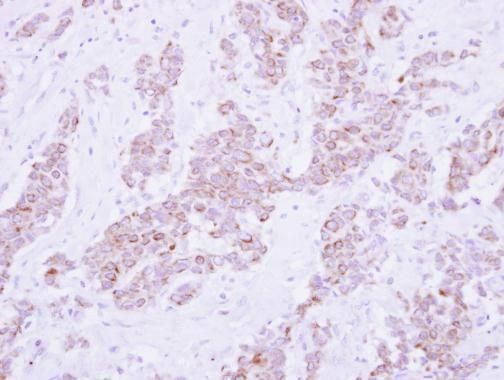 Immunohistochemical analysis of PSD4 in paraffin-embedded breast carcinoma using a PSD4 polyclonal antibody (Product # PA5-31837) at a dilution of 1:250.