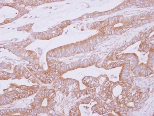 Immunohistochemical analysis of THUMPD2 in paraffin-embedded colon carcinoma using a THUMPD2 polyclonal antibody (Product # PA5-32045) at a dilution of 1:500.