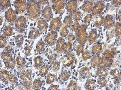 Immunohistochemical analysis of RUNDC1 in paraffin-embedded colon carcinoma using a RUNDC1 polyclonal antibody (Product # PA5-31987) at a dilution of 1:500.