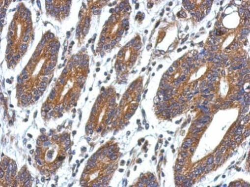 Immunohistochemical analysis of CCDC127 in paraffin-embedded colon carcinoma using a CCDC127 polyclonal antibody (Product # PA5-32051) at a dilution of 1:500.