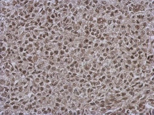 Immunohistochemical analysis of DNAJB7 in paraffin-embedded D54 xenograft using a DNAJB7 polyclonal antibody (Product # PA5-32109) at a dilution of 1:500.