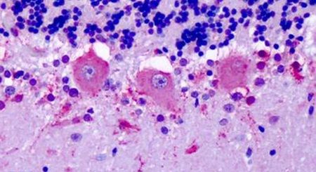 Immunohistochemical analysis of formalin-fixed paraffin-embedded human brain, cerebellum, Purkinje neurons using a OR6N1 polyclonal antibody (Product # PA5-34059) at a 6-14 ug/ml dilution. Heat-induced antigen retrieval was performed prior to staining.