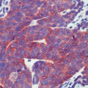 Formalin-fixed, paraffin-embedded human lung small cell carcinoma stained with Cadherin,pan antibody using peroxidase-conjugate and AEC chromogen. Note membrane staining of tumor cells.