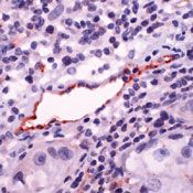 Formalin-fixed, paraffin-embedded human Lung Ca stained with eNOS antibody using peroxidase-conjugate and AEC. Note staining of endothelium of vessel.