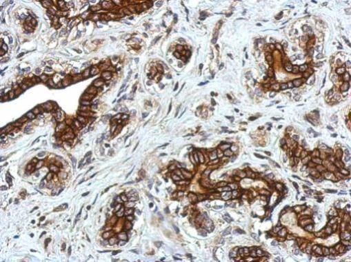 Immunohistochemical analysis of alpha 2 Glycine Receptor in paraffin-embedded breast carcinoma using an Alpha 2 Glycine Receptor polyclonal antibody (Product # PA5-21673) at a dilution of 1:750.
