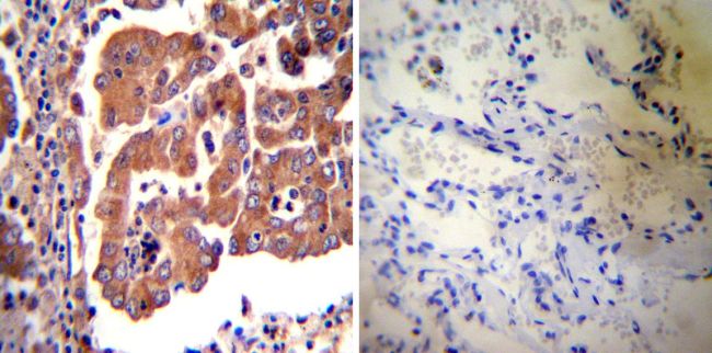 Immunohistochemistry was performed on cancer biopsies of deparaffinized Human lung adenocarcinoma tissues. To expose target proteins, heat induced antigen retrieval was performed using 10mM sodium citrate (pH6.0) buffer, microwaved for 8-15 minutes. Following antigen retrieval tissues were blocked in 3% BSA-PBS for 30 minutes at room temperature. Tissues were then probed at a dilution of 1:20 with a rabbit polyclonal antibody recognizing eNOS (PA3-031A) or without primary antibody (negative control) overnight at 4°C in a humidified chamber. Tissues were washed extensively with PBST and endogenous peroxidase activity was quenched with a peroxidase suppressor. Detection was performed using a biotin-conjugated secondary antibody and SA-HRP, followed by colorimetric detection using DAB. Tissues were counterstained with hematoxylin and prepped for mounting.