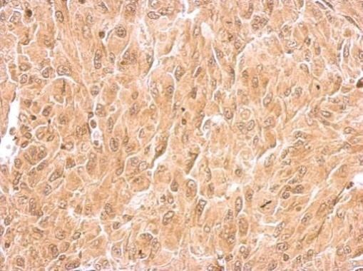 Immunohistochemical analysis of RIN2 in the cytosol of paraffin-embedded U87 xenograft using a RIN2 polyclonal antibody (Product # PA5-30882) at a dilution of 1:500.