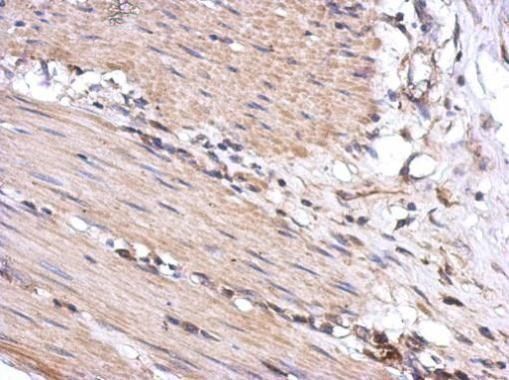 Immunohistochemical analysis of SGK493 in paraffin-embedded colon carcinoma using a SGK493 polyclonal antibody (Product # PA5-30893) at a dilution of 1:500.