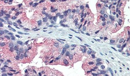Immunohistochemical analysis of formalin-fixed paraffin-embedded prostate, human using a TM9SF3 polyclonal antibody (Product # PA5-34267) at a 10 ug/ml dilution. Heat-induced antigen retrieval was performed prior to staining.