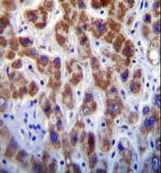 Immunohistochemistry analysis of GOG8A in formalin-fixed, paraffin-embedded human liver tissue using a GOG8A polyclonal antibody (Product # PA5-35036) followed by peroxidase conjugation of the secondary antibody and DAB staining.