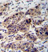 Immunohistochemistry analysis of WDR42C in formalin-fixed, paraffin-embedded human breast carcinoma using a WDR42C polyclonal antibody (Product # PA5-35082) followed by peroxidase conjugation of the secondary antibody and DAB staining.