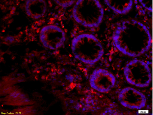Formalin-fixed and paraffin embedded human colon cancer labeled with Anti-GPR65 Polyclonal Antibody, Unconjugated (bs-6436R) at 1:200 followed by conjugation to the secondary antibody Goat Anti-Rabbit IgG, Cy3 conjugated(bs-0295G-Cy3) used at 1:200 dilution for 40 minutes at 37°C and DAPI staining