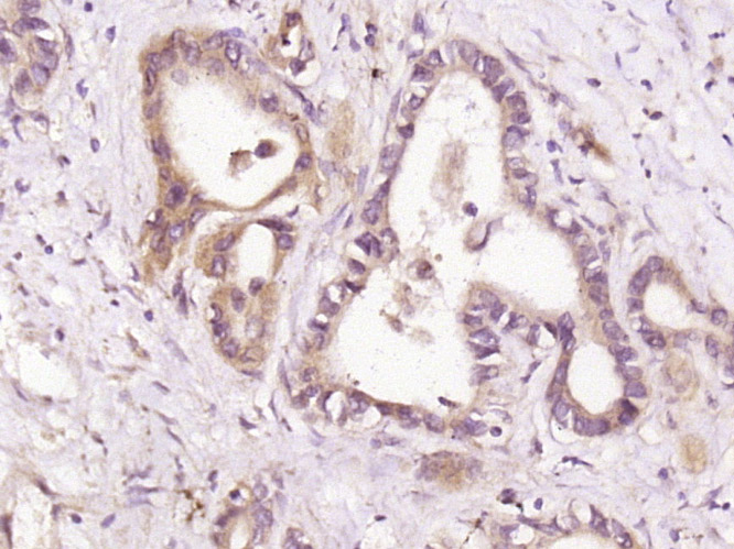 Paraformaldehyde-fixed, paraffin embedded human stomach cancer; Antigen retrieval by boiling in sodium citrate buffer (pH6) for 15min; Block endogenous peroxidase by 3% hydrogen peroxide for 30 minutes; Blocking buffer (normal goat serum) at 37°C for 20min; Antibody incubation with HDPTP Polyclonal Antibody (bs-15434R) at 1:400 overnight at 4°C, followed by a SP kit and DAB staining.