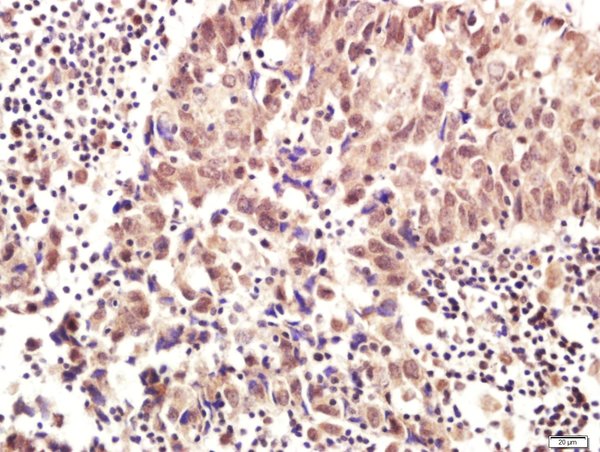 Paraformaldehyde-fixed, paraffin embedded human cervical cancer tissue; Antigen retrieval by boiling in sodium citrate buffer(pH6) for 15min; Block endogenous peroxidase by 3% hydrogen peroxide for 20 minutes; Blocking buffer (normal goat serum) at 37°C for 30min; Antibody incubation with RNF169 Polyclonal Antibody, Unconjugated (bs-9259R) at 1:400 overnight at 4°C, followed by a conjugated secondary and DAB staining
