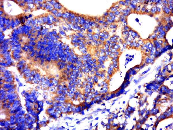 Paraformaldehyde-fixed, paraffin embedded human colon carcinoma; Antigen retrieval by boiling in sodium citrate buffer (pH6.0) for 15min; Block endogenous peroxidase by 3% hydrogen peroxide for 20 minutes; Blocking buffer (normal goat serum) at 37°C for 30min; Antibody incubation with C21ORF62 Polyclonal Antibody, Unconjugated (bs-9975R) at 1:500 overnight at 4°C, followed by a conjugated secondary for 20 minutes and DAB staining.