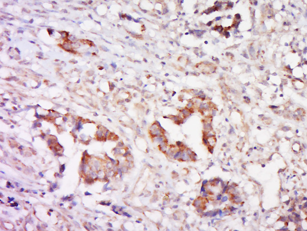 Paraformaldehyde-fixed, paraffin embedded human cervical cancer; Antigen retrieval by boiling in sodium citrate buffer (pH6) for 15min; Block endogenous peroxidase by 3% hydrogen peroxide for 30 minutes; Blocking buffer (normal goat serum) at 37°C for 20min; Antibody incubation with Rabbit Anti-Cathepsin L Polyclonal Antibody, Unconjugated (bs-1508R) at 1:200 overnight at 4°C, followed by a conjugated secondary and DAB staining.