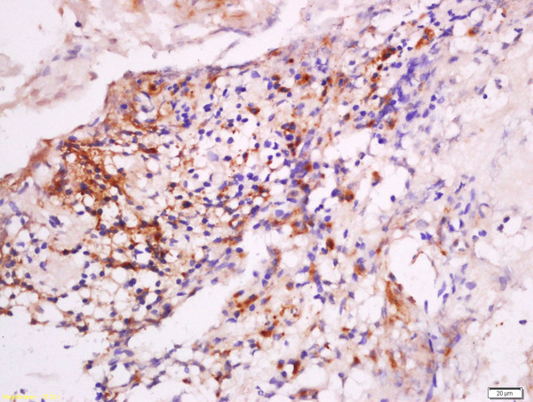 Formalin-fixed and paraffin embedded human laryngocarcinoma labeled with Anti-DNase II Polyclonal Antibody, Unconjugated (bs-7652R) at 1:200 followed by conjugation to the secondary antibody and DAB staining.