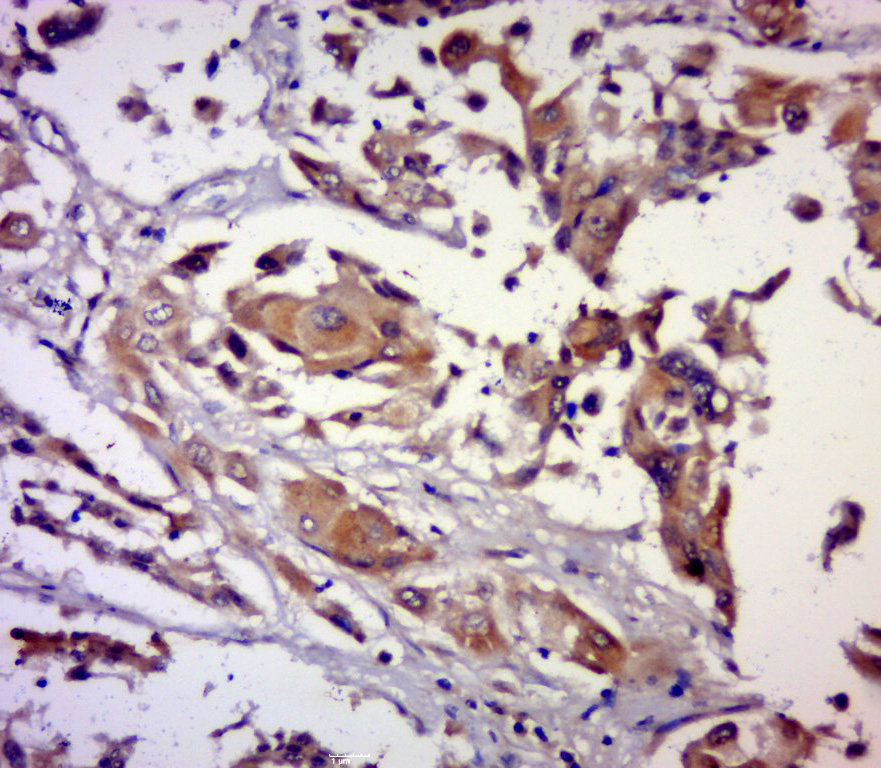 Paraformaldehyde-fixed, paraffin embedded human breast carcinoma; Antigen retrieval by boiling in sodium citrate buffer (pH6.0) for 15min; Block endogenous peroxidase by 3% hydrogen peroxide for 20 minutes; Blocking buffer (normal goat serum) at 37°C for 30min; Antibody incubation with DRES17 Polyclonal Antibody, Unconjugated (bs-6299R) at 1:400 overnight at 4°C, followed by a conjugated secondary for 20 minutes and DAB staining.