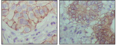 Immunohistochemical analysis of paraffin-embedded human lung cancer (left) and colon cancer (right) showing cytoplasmic localization with DAB staining using EphB1 mouse mAb