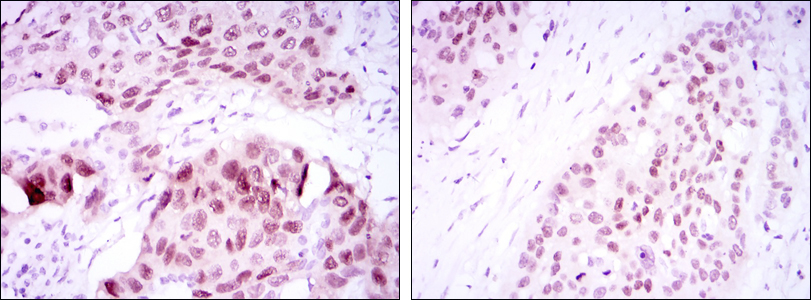Immunohistochemical analysis of paraffin-embedded lung cancer tissues (left) and esophageal cancer tissues (right) using SOX2 mouse mAb with DAB staining