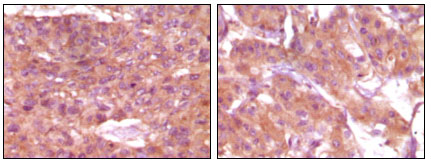 Immunohistochemical analysis of paraffin-embedded human skin carcinoma (left) and breast carcinoma (right), showing cytoplasmic and membrane localization using SRA mouse mAb with DAB staining