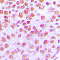 Immunohistochemical analysis of Cytokine IK staining in human breast cancer formalin fixed paraffin embedded tissue section. The section was pre-treated using heat mediated antigen retrieval with sodium citrate buffer (pH 6.0). The section was then incubated with the antibody at room temperature and detected using an HRP conjugated compact polymer system. DAB was used as the chromogen. The section was then counterstained with haematoxylin and mounted with DPX.
